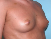 Patient # 59892 Before Photo # 1